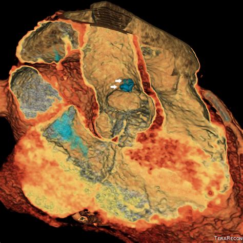 A The Three Dimensional 3d Contrast Enhanced Coronary Ct