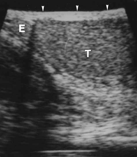 Tuberculous Epididymitis And Epididymo Orchitis Sonographic Appearances Ajr