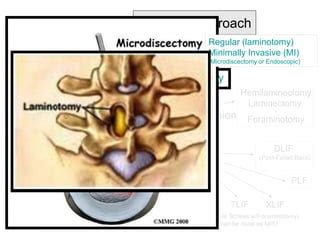 Laminectomy vs Discectomy in Rehabilitation | PPT