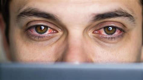 Tired eyes reflecting digital screen, showing signs of strain and