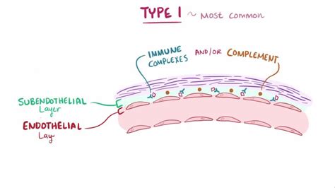 Membranoproliferative Glomerulonephritis Genitourinary Disorders