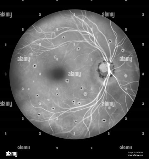 Illustration Of A Retina Affected By Presumed Ocular Histoplasmosis