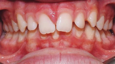 Class Ii Subdivision Left Malocclusion Excessive Overjet And Overbite Case Gallery