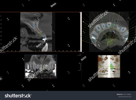 Teeth Nerve Filling 3d Over 8 Royalty Free Licensable Stock Photos