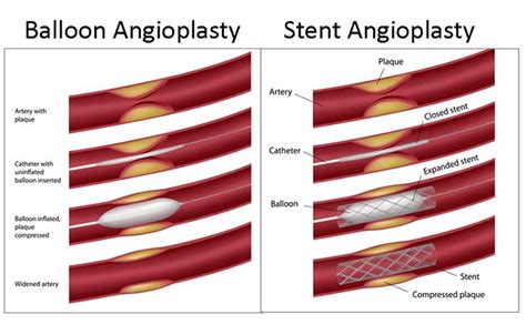 Pin by Self Catheters on Different Catheters | Pinterest