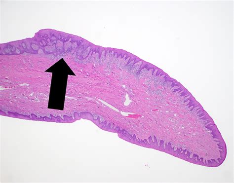 Epulis Fissuratum Histologie