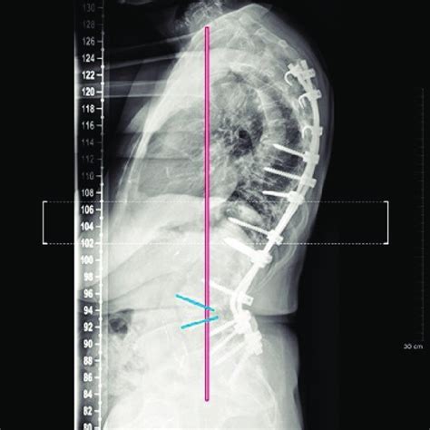 Preoperative Standing Lateral View X Ray Figure Preop Standing