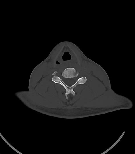 Arrow Injury To The Face Radiopaedia Axial Bone Window