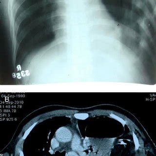 Radiograph of the chest posteroanterior view with loculated ...