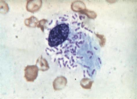 19 Donovan Bodies Giemsa Stained Smear From Genital Ulcer