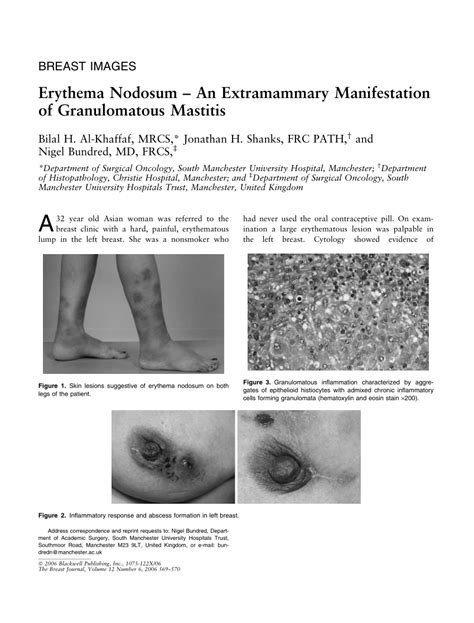 Pdf Erythema Nodosum An Extramammary Manifestation Of Granulomatous