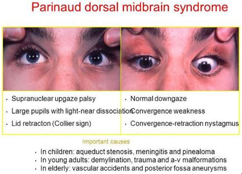 PAEDS : Pinealoma in Children/Parinaud's Dorsal Midbrain Syndrome ...