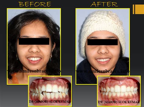 Severe Constriction Of Maxillary Arch Corrected By Orthodontics