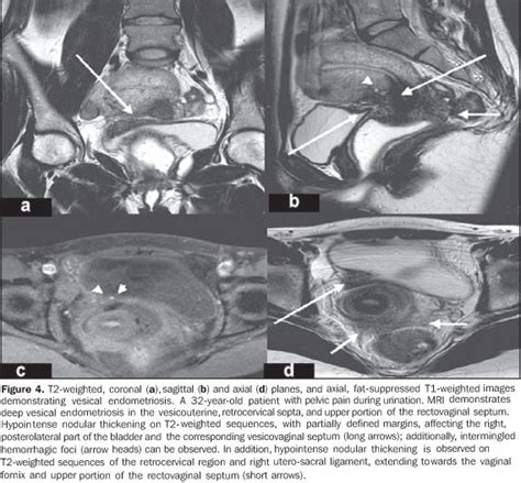 Scielo Brasil Resson Ncia Magn Tica Na Endometriose P Lvica