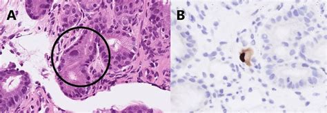 Pathological presentation of CMV gastritis . CMV gastritis was... | Download Scientific Diagram