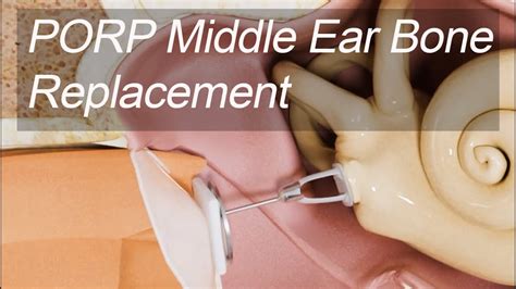 Malleus Incus Replacement Partial Ossicular Replacement Prosthesis