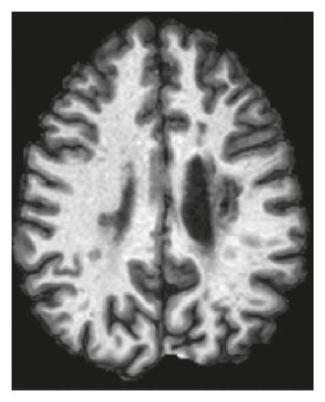 Multiple Sclerosis Lesion Segmentation In Brain Mri Using Inception Modules Embedded In A