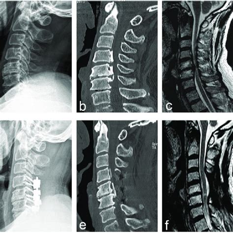 age related radiographic incidence  olisthesis opll  oall