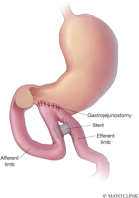 Management Of Afferent Limb Obstruction By Use Of EUS Guided Creation