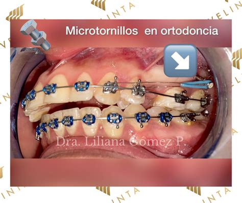 Ortoimplantes Cl Nica Velinta