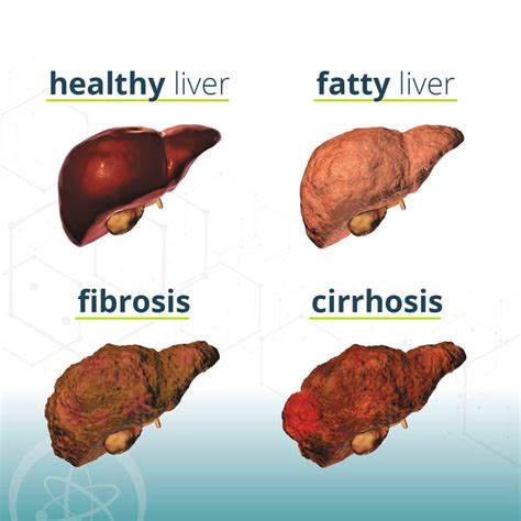 MASH Causes, Symptoms and Treatments - Florida Research Institute