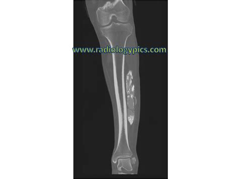 Solution To Unknown Case Calcific Myonecrosis Radiologypics