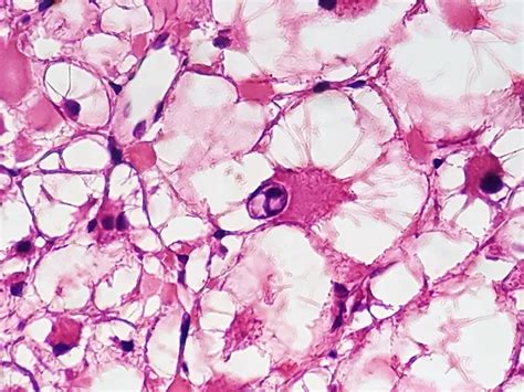 Cardiac Rhabdomyoma : Histology