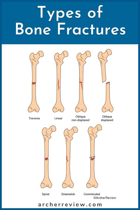 Nclex Tip Types Of Bone Fractures Types Of Bones Bone Fracture Fractures