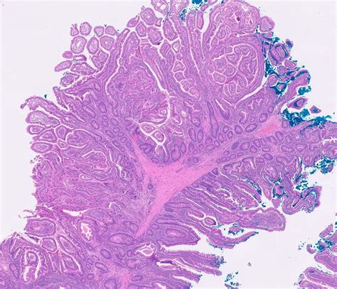 Peutz Jeghers Polyp Histology