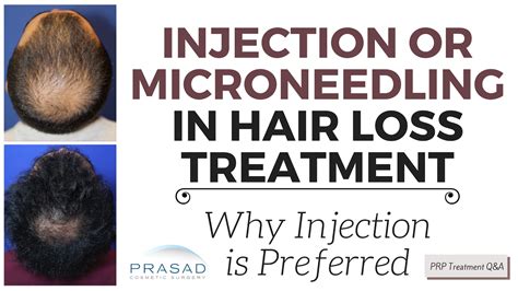 Prp And Prp Combination Hair Loss Treatments Why Injections Are Preferred Over Microneedling