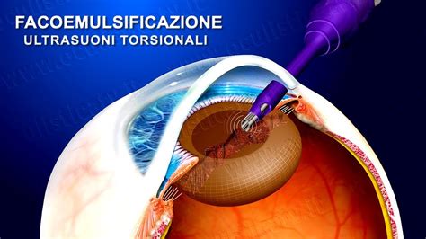 Cataratta Terapia Chirurgica Con Ultrasuoni Torsionali