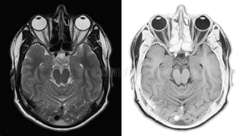 Realistic Cross Section of Brain with CT Scan, MRI Magnetic Resonance Imaging of Head Layer ...