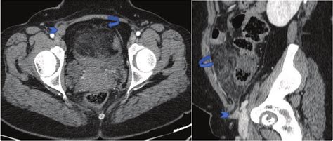 Secondary Omental Infarction A Year Old Lady Presenting With Acute