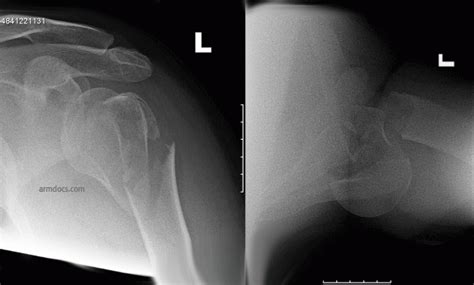 Proximal Humerus Fracture - Operative Fixation | Arm Docs