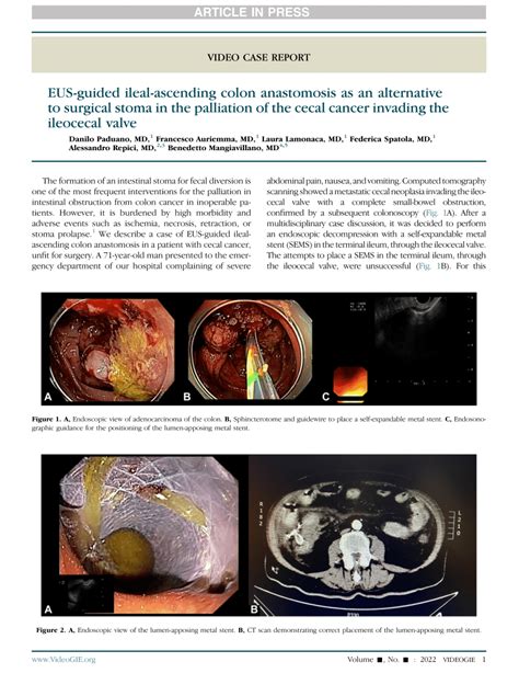 Pdf Eus Guided Ileal Ascending Colon Anastomosis As An Alternative To