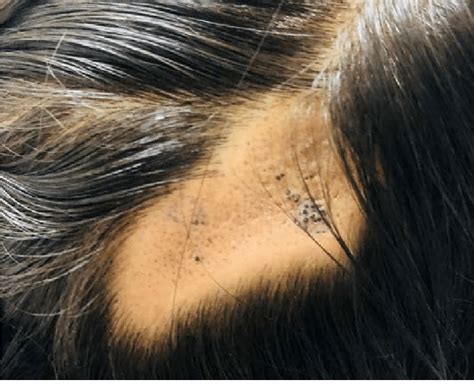 Multiple Keratin Filled Pits On Scalp Download Scientific Diagram