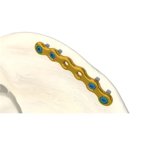 Variable Angle Mm Distal Medial Humeral Lcp Orthopedic Trauma