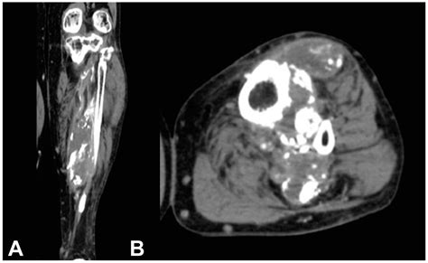 Medicina Free Full Text Calcific Myonecrosis Of The Leg A Rare Entity