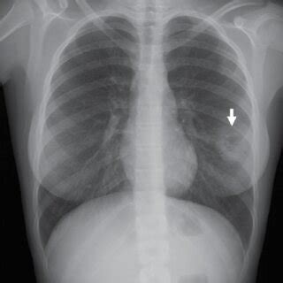 Chest Radiograph Anterior Posterior Showing Reversed Halo Sign