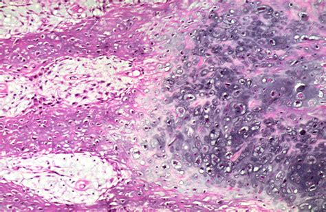 Pathology Outlines Bizarre Parosteal Osteochondromatous Proliferation