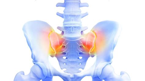 ISG Arthrose Symptome Diagnose Behandlung Medisiegel De