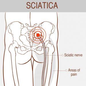 Sciatica: 3 exercises for sciatic nerve flossing - Evercore - Move With ...