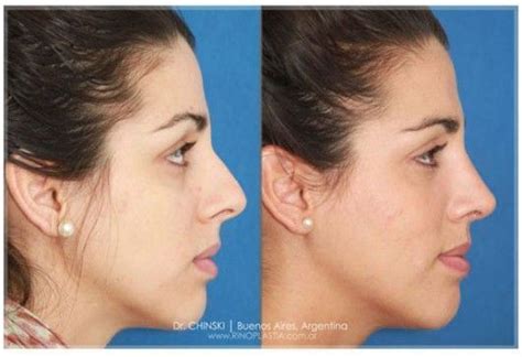 Fotos Antes Y Después De Una Rinoplastía Rinoplastia Blog