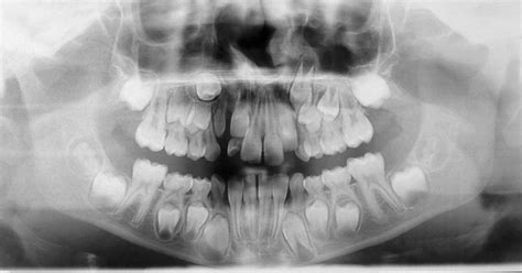 Alveolar Cleft Reconstruction With Vomerine Bone Two Surgical