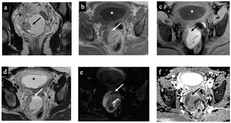 Cancers Free Full Text Prediction Of The Risk Of Malignancy Of