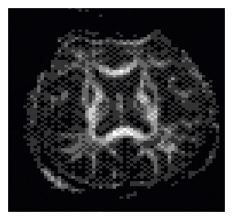 FA measurement and DTI fiber tracking. (a) FA measurement map. (b ...