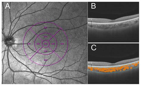 Methods To Measure Choroidal Vascularity Index Cvi A The Etdrs Download Scientific Diagram