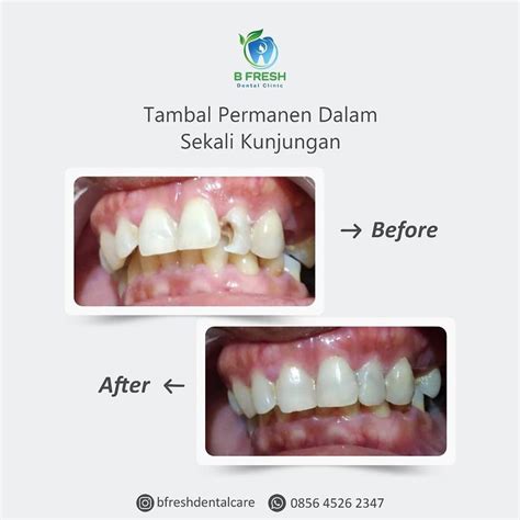 Tambal Gigi Bfresh Dental Care