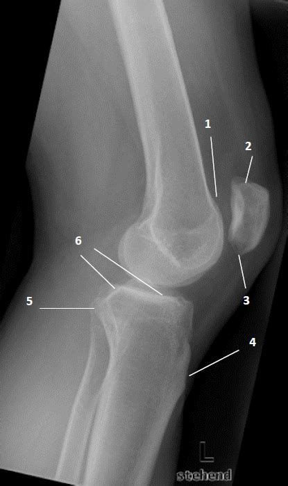 R Ntgenanatomie Knie Seitlich M L Diagram Quizlet