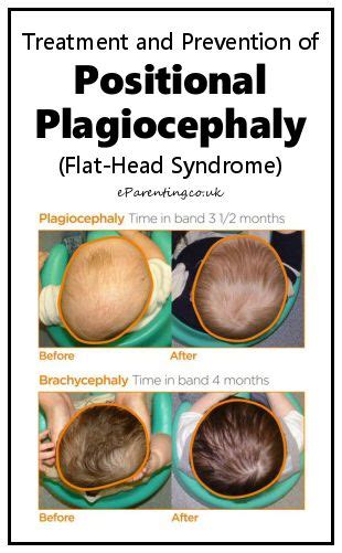 Positional Plagiocephaly